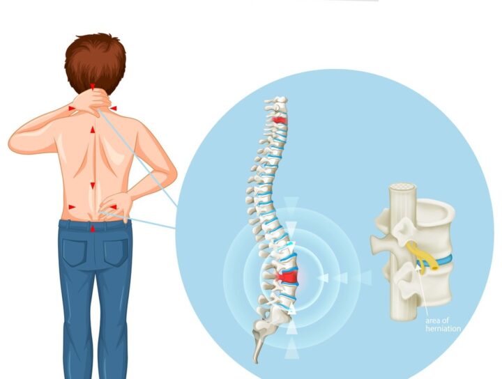 herniated disc surgery in pune