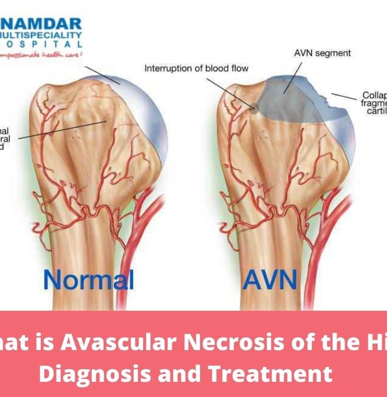 Avascular Necrosis of the Hip
