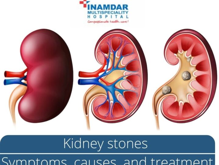 Kidney Stone Treatment in Pune | Inamdar Hospital