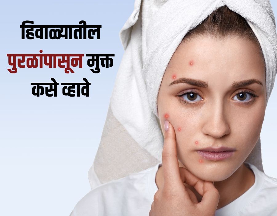 acne treatment | Winter skin treatment | Derma care