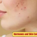 Link Between Hormones and Skin Conditions