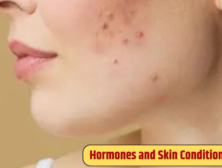 Link Between Hormones and Skin Conditions